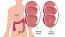 Kolon Kanseri Çeşitleri Nelerdir? Kolon Kanseri Çeşitleri Nelerdir?