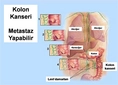 Kolon Kanseri Metastaz Kolon Kanseri Metastaz