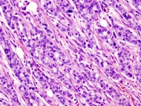 Adenokarsinom Kolon Adenokarsinom Kolon