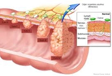 Kolon Ca Belirtileri ve Tedavisi Kolon Ca Belirtileri ve Tedavisi