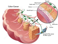 Kolon Kanseri İlaçları Kullanımı ve Faydaları Nelerdir? Kolon Kanseri İlaçları Kullanımı ve Faydaları Nelerdir?