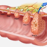 Kolon Kanseri Kemoterapi Belirtileri ve Tedavisi Kolon Kanseri Kemoterapi Belirtileri ve Tedavisi