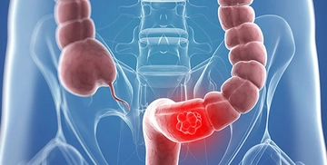 Kolon Türleri ve Özellikleri Kolon Türleri ve Özellikleri