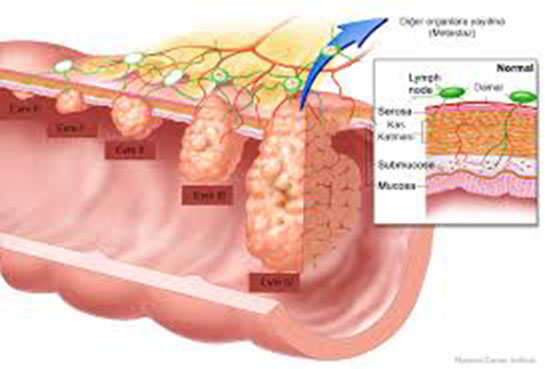 Kolon Ca Belirtileri ve Tedavisi