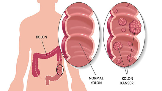 Kolon Kanseri eitleri