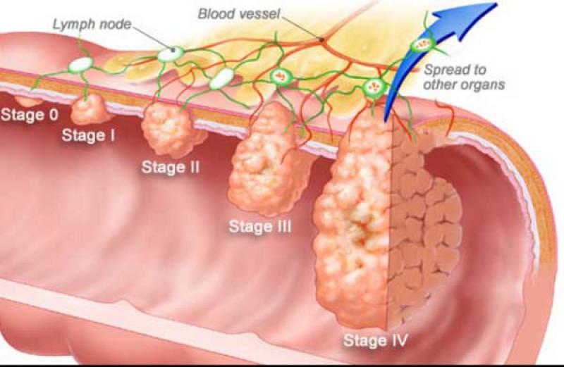 Kolon Polipleri Belirtileri ve Tedavisi