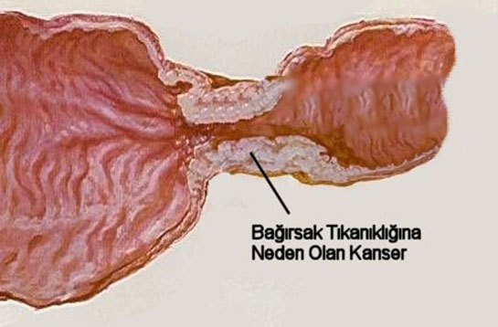 Kolon Tümörü Belirtileri ve Tedavisi