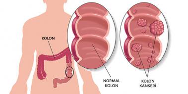 Kolon Kanseri eitleri